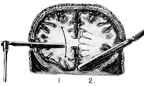 Lobotomy前部前頭葉切截術 Occult A La Carte